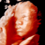 2/3D echo